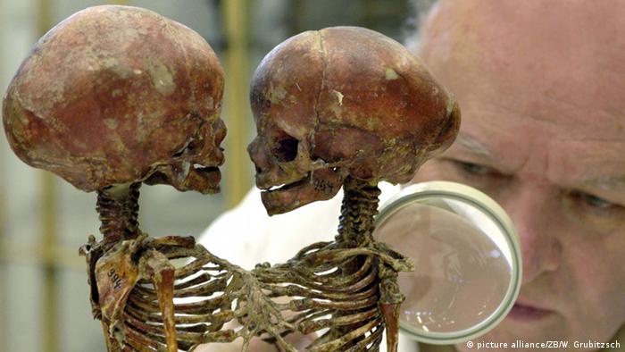Скелеты сиамских близнецов из коллекции в Галле