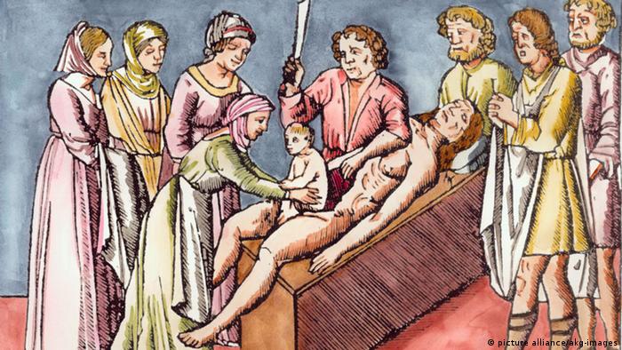 Кесарево сечение на рисунке 1506 года